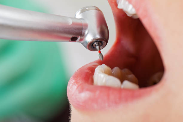 Best Emergency Dental Care for Broken or Chipped Teeth in Frankfort, OH